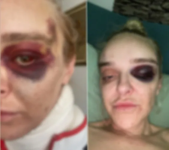 JEZIVA PRIČA PRETUČENE DOKTORICE ZA HAYAT.BA: POKUŠAVAJU SVE ZATAŠKATI!