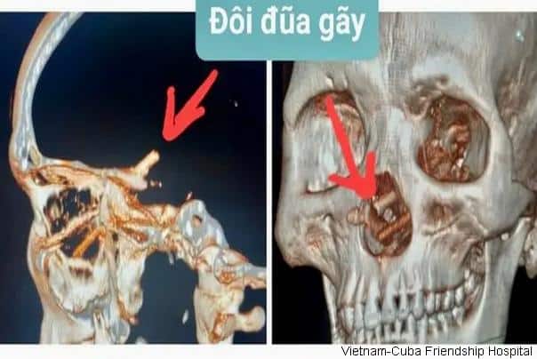 Imao Je Dva Stapa Zaboden U Nos Ili U Mozak