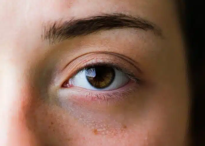 Dermatolozi savjetuju kako se riješiti podočnjaka Dermatolozi Savjetuju Kako Se Rijesiti Podocnjaka