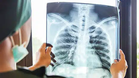 RAK PLUĆA JE NAJČEŠĆI, U FBIH BILJEŽI SE ZNAČAJAN RAST Rak Pluca Je Najcesci U Fbih Biljezi Se Znacajan Rast