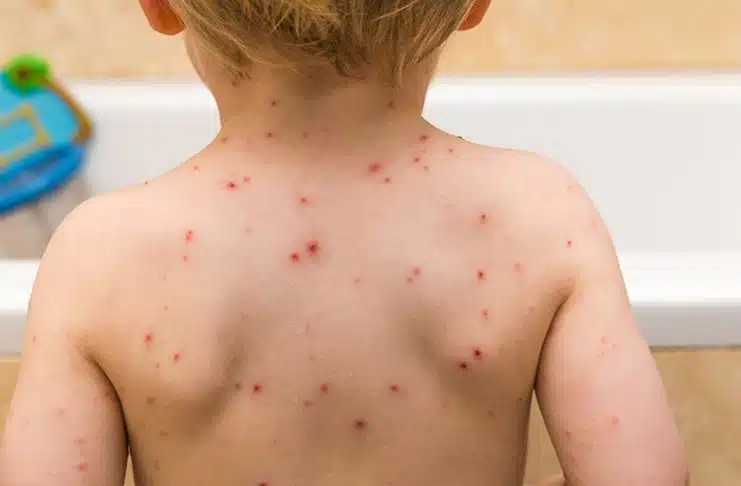 Epidemija morbila u Kantonu Sarajevo: Roditelji, vakcinišite svoju djecu!
