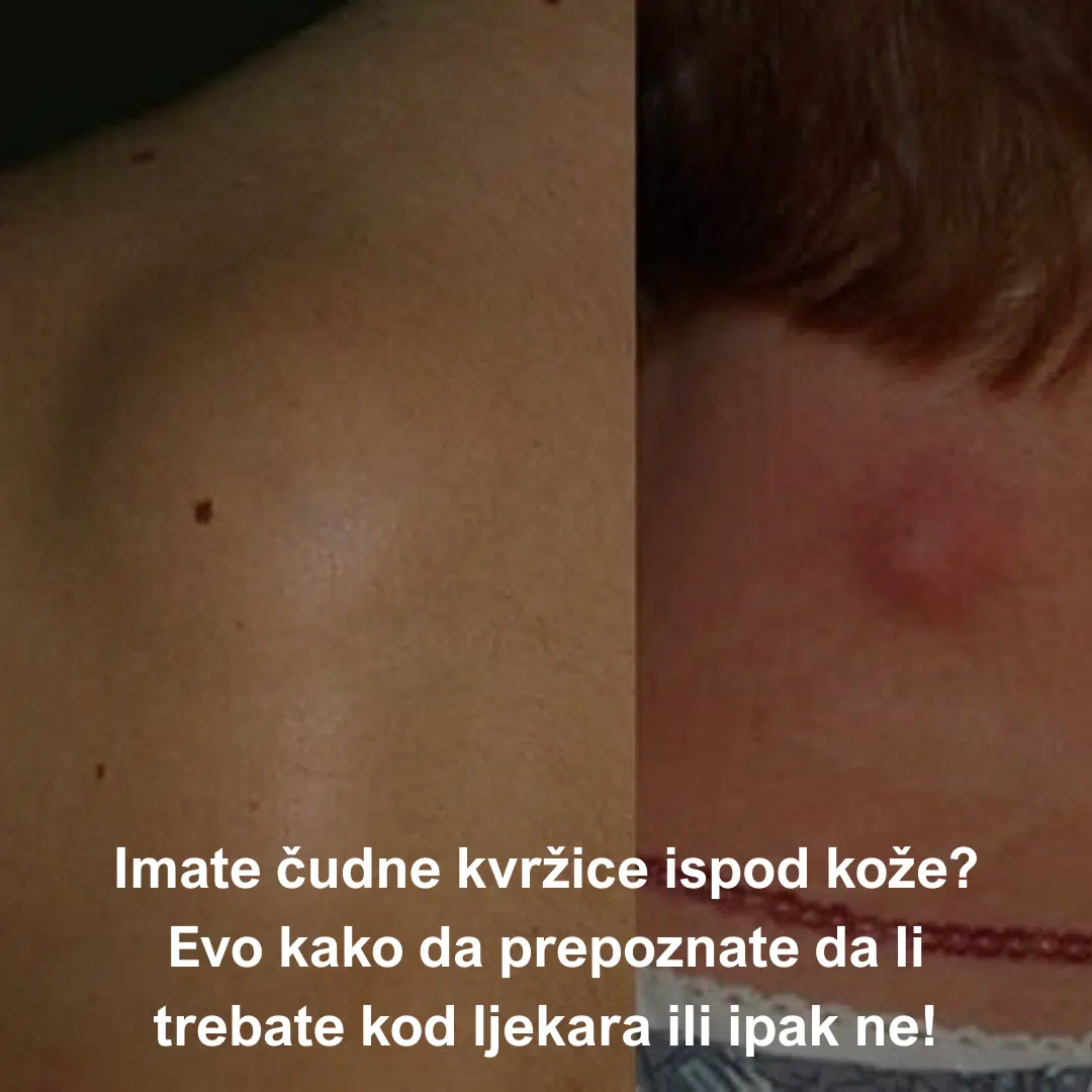 Imate čudne kvržice ispod kože? Evo kako da prepoznate da li trebate kod ljekara ili ipak ne!