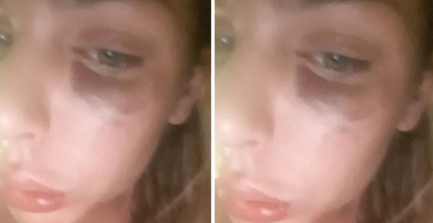 Ava Karabatić pokazala povrede i iznijela potresnu ispovijest: “Trpila sam nasilje jer sam se nadala trudnoći…”